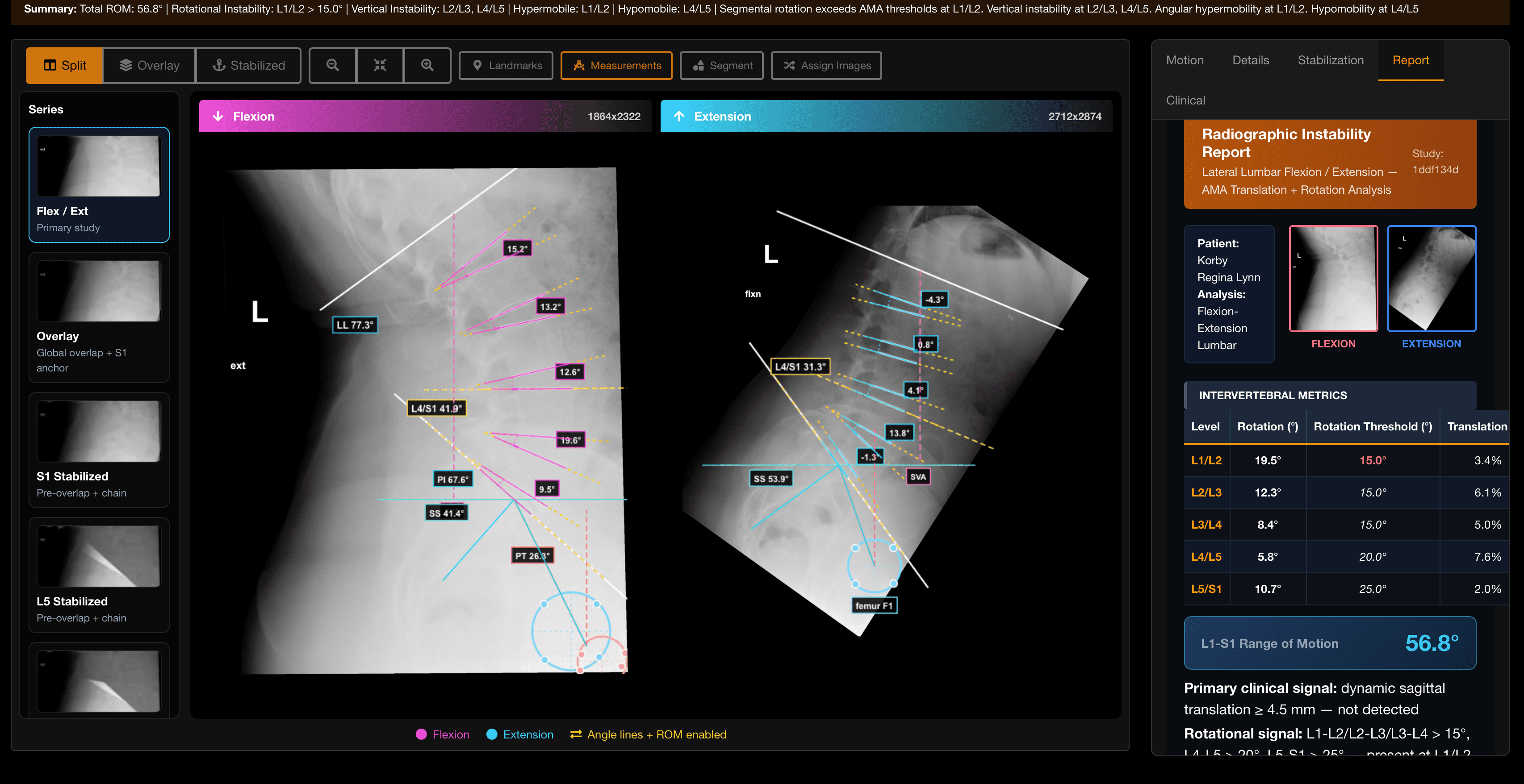 MotionVision side-by-side flexion/extension comparison