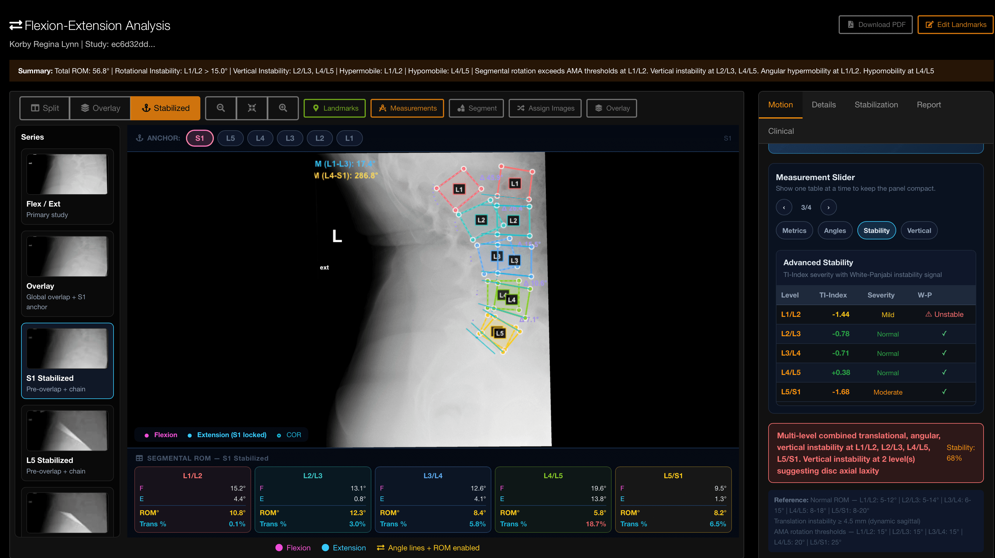 MotionVision stabilized overlay with TI-Index and White–Panjabi signal