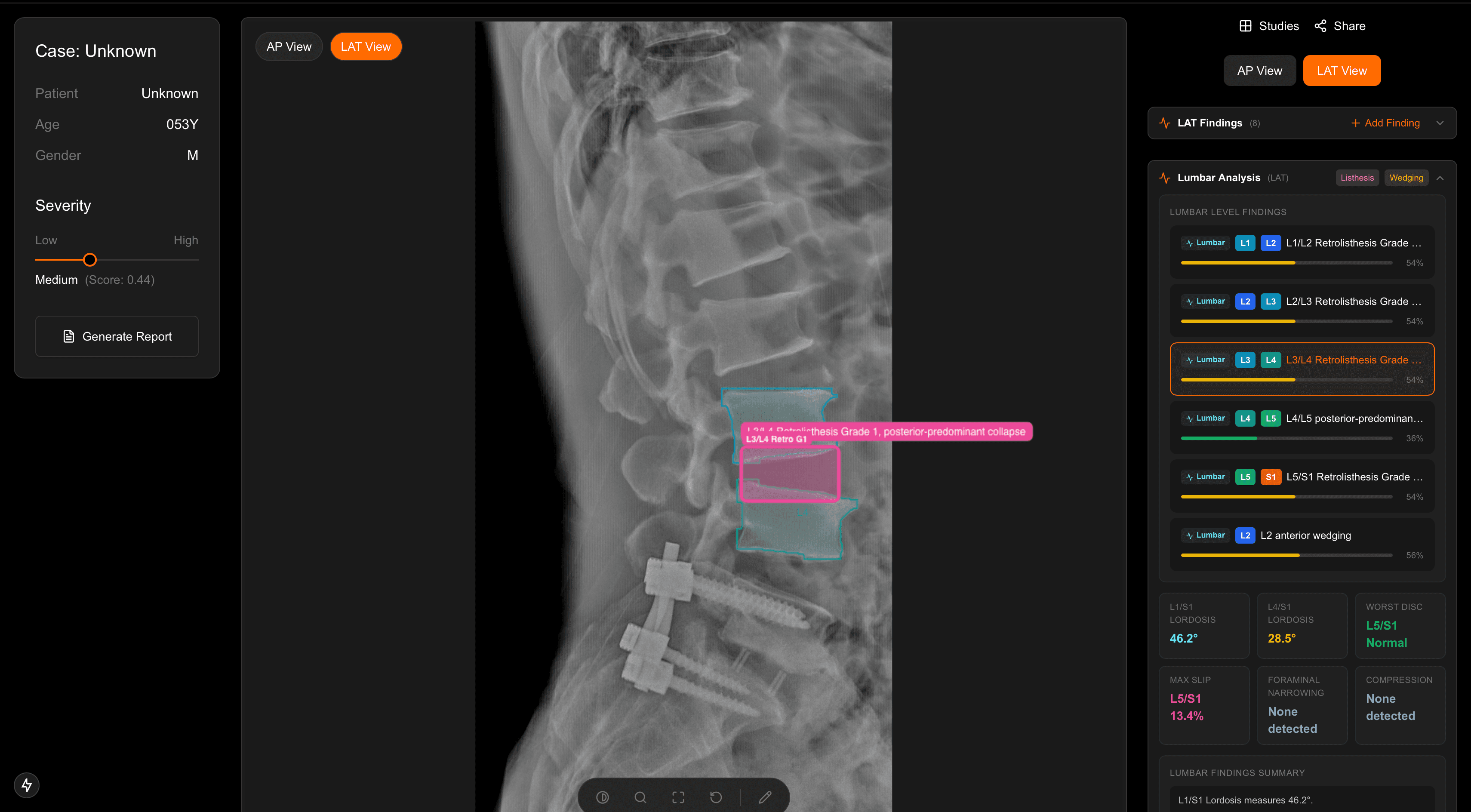 SpineVision lumbar analysis panel with retrolisthesis grading