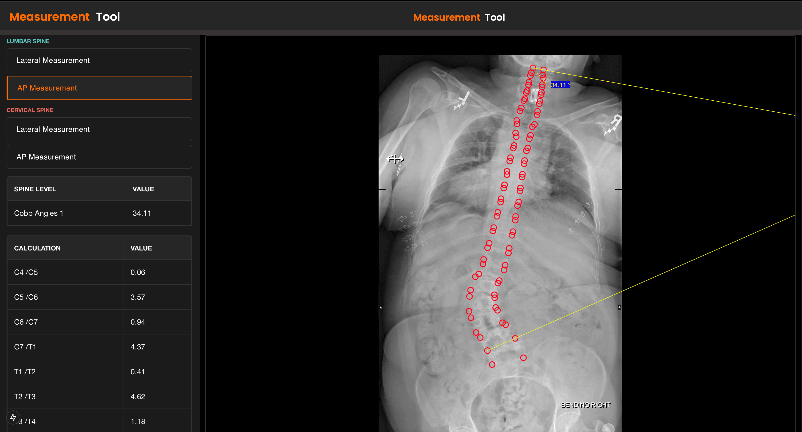 SpineVision AP measurement workspace