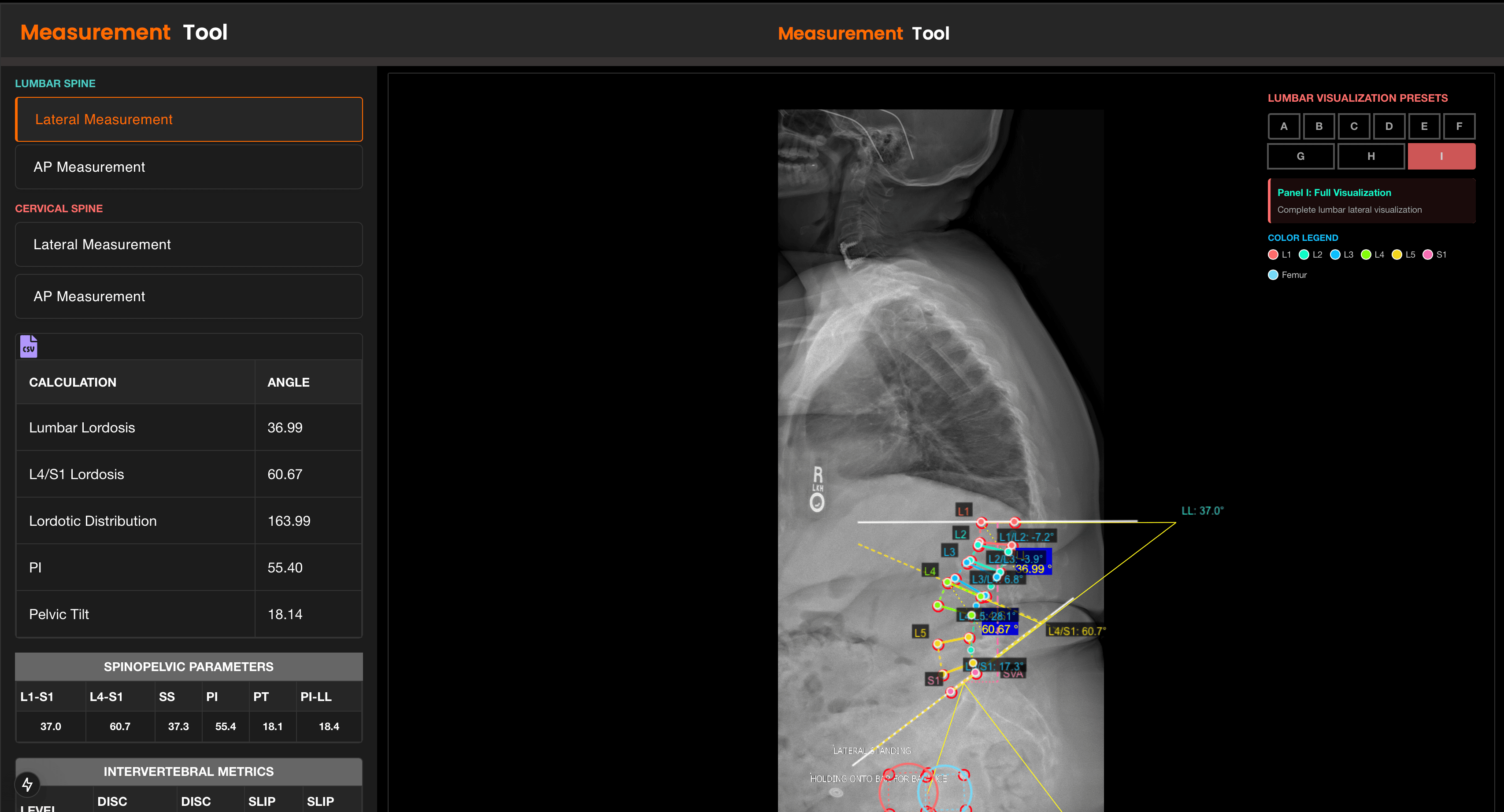 SpineVision lumbar lateral measurement workspace