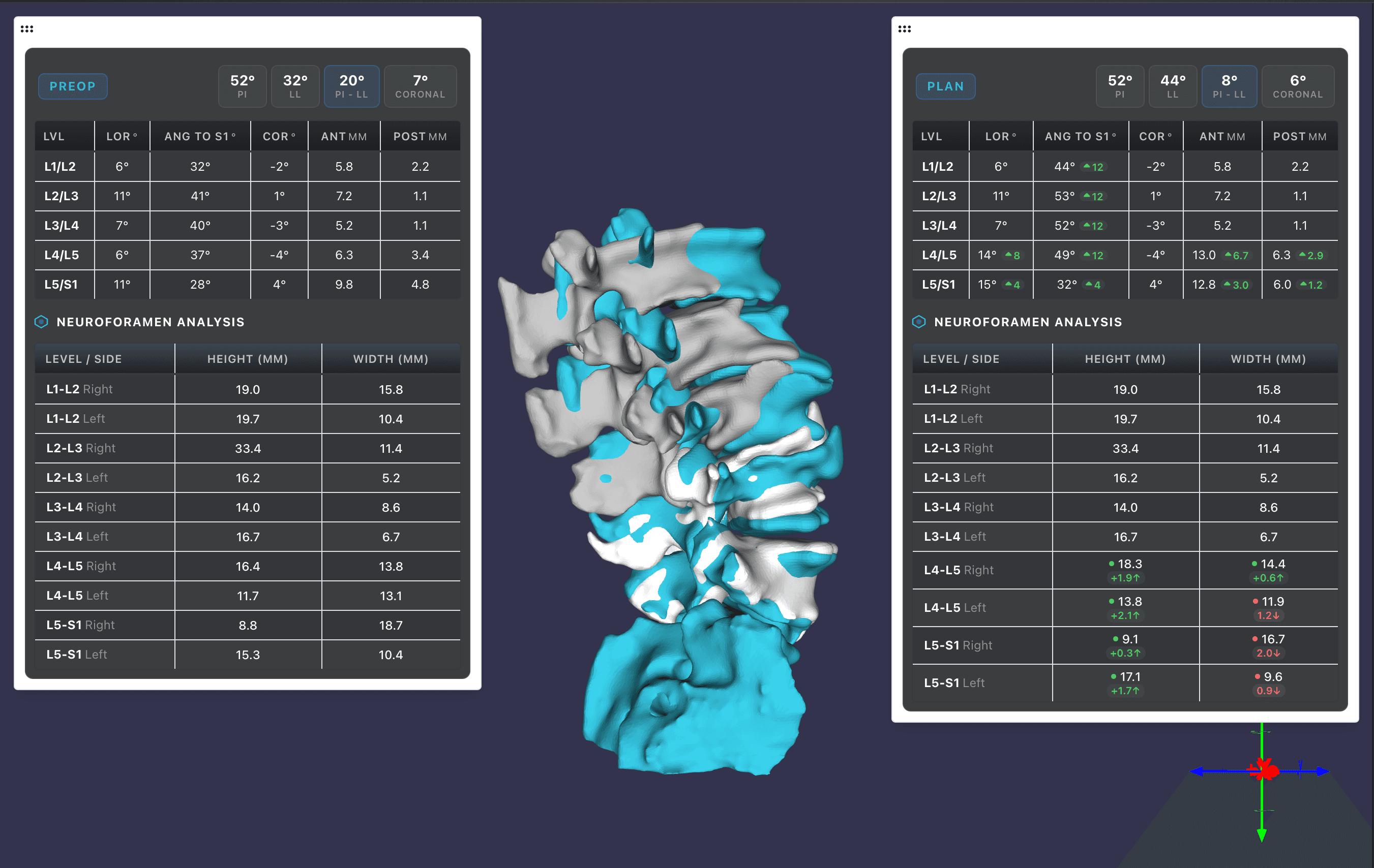 SurgiVision pre-op vs. plan comparison