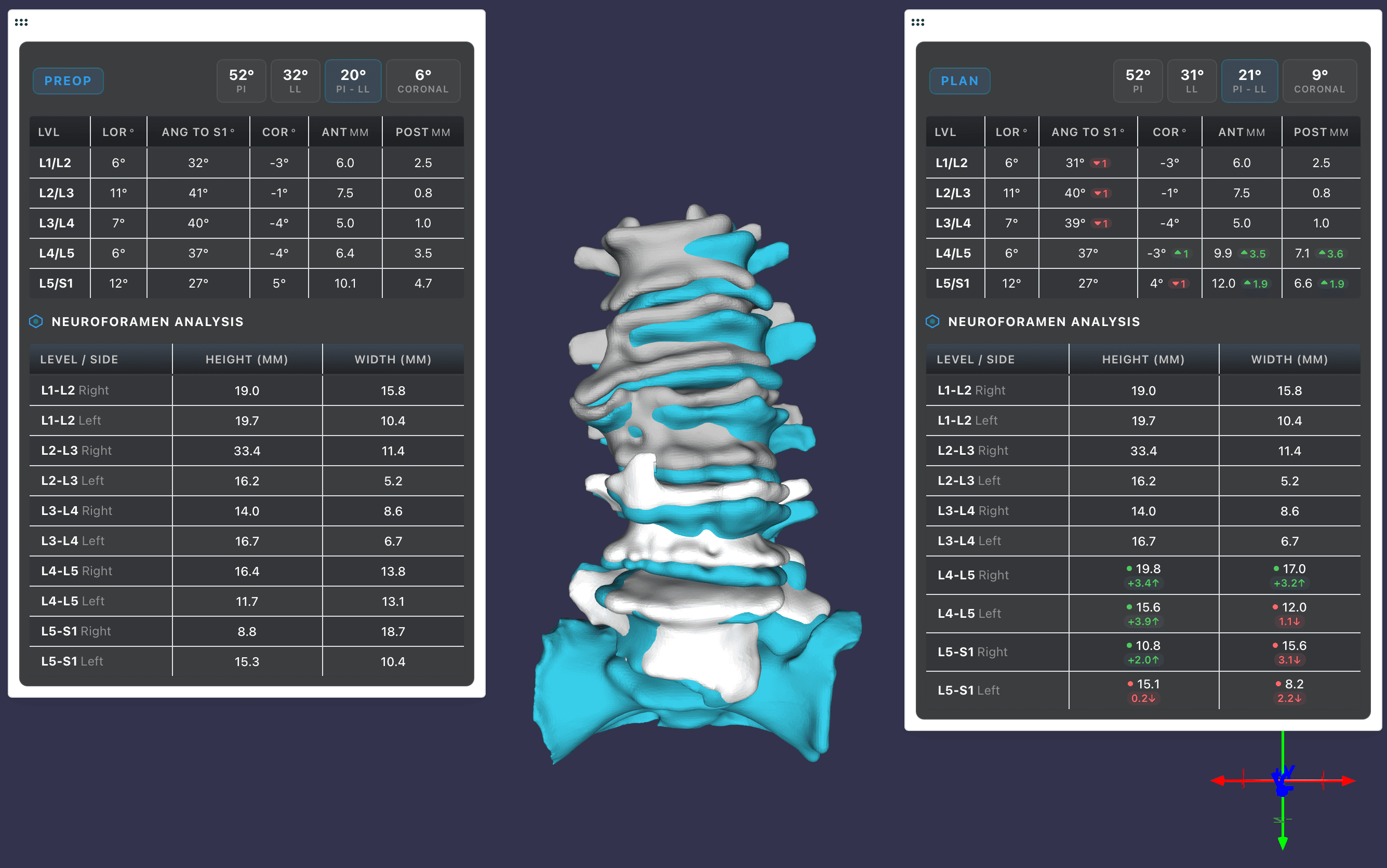 Full spine pre-op vs. plan 3D overlay